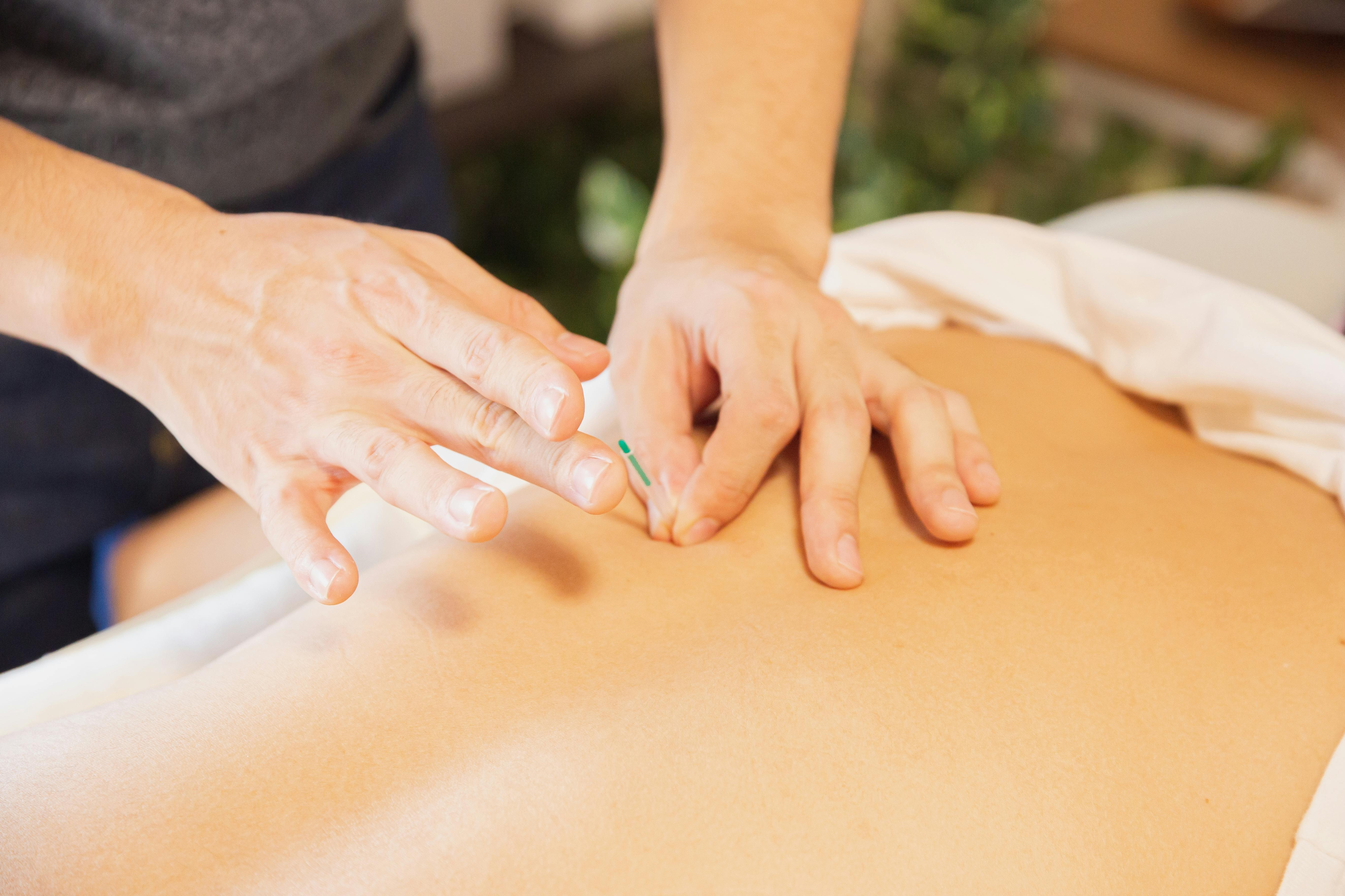 Acupuncture treatment illustration at King’s Lynn Chiropractic Clinic